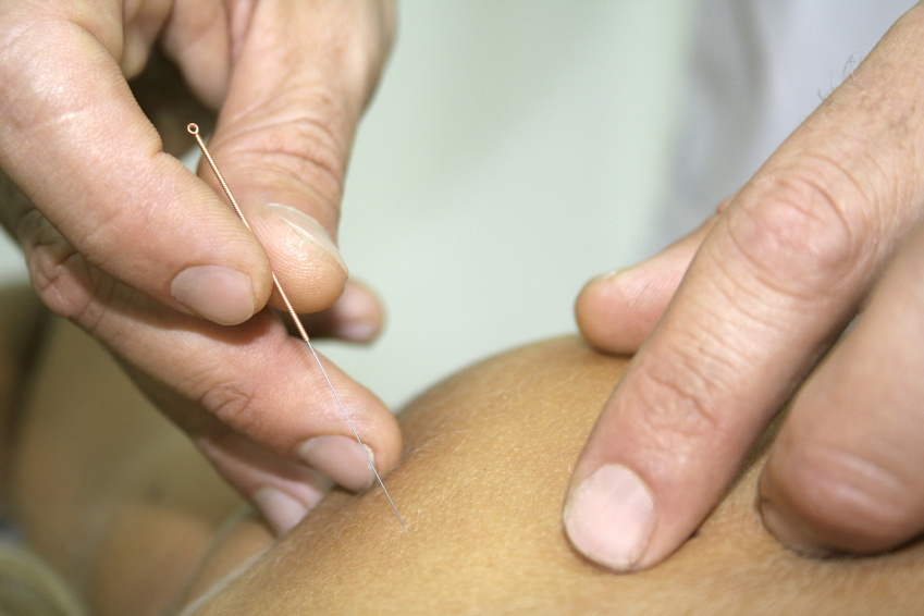 Acupuncture treatment